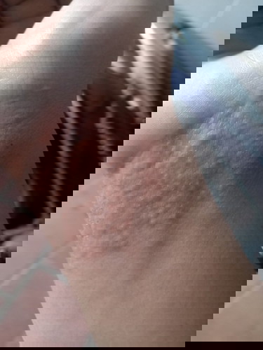 Có m nào bị ngứa giống e ko ạ 😭.