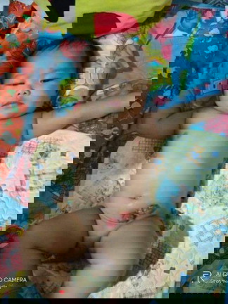 Inferporate annus
Conginital cataract