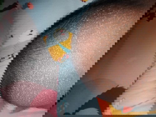 Kulit jidat melenting