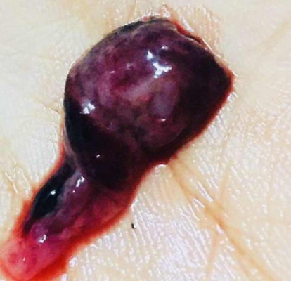 ก้อนเลือดออกมาแบบนี้คืออะไรคะ🥺😂