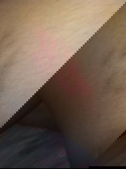 Gatal seperti terbakar