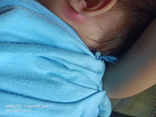 Benjolan belakang daun telinga