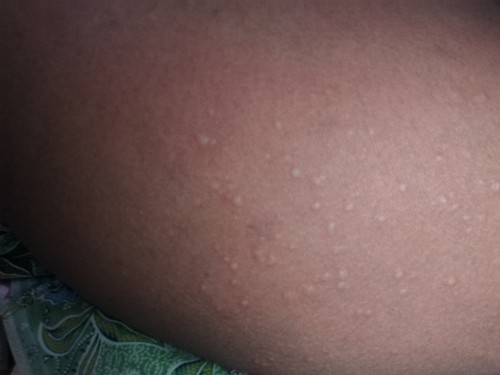 ผื่นคันทั้งตัว ท้อง37สัปดาห์
ไปหาหมอมาให้ยาแก้แพ้คัน เม็ดสีขาว กับสีเหลือง กินได้ไหมค่ะ ตอนนี้คันมาก