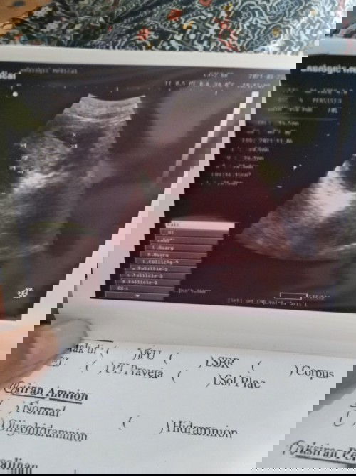 Lagi hamil tapi ada kista