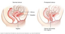 Uterine Prolapse