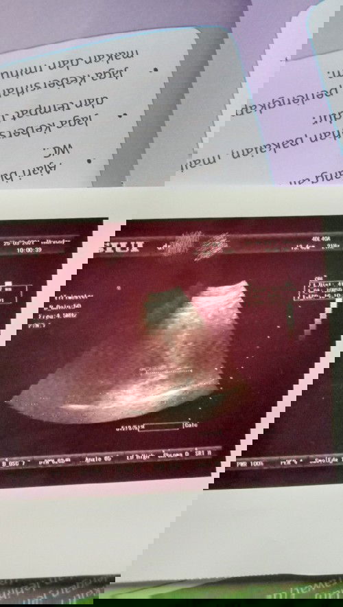 Hasil foto usg ga jelas