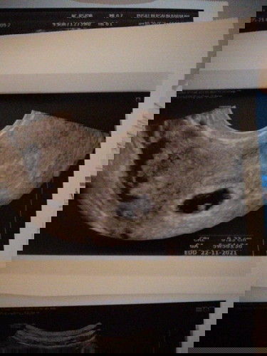 Threatened Miscarriage