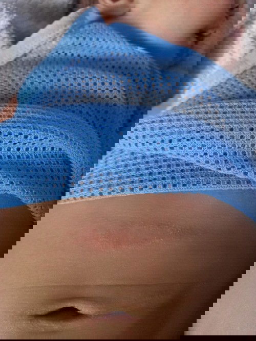 อาการแพ้ ผื่น รบกวนค่ะ