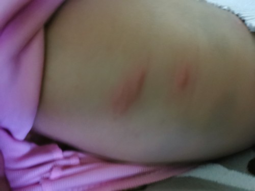 Rashes bintik merah