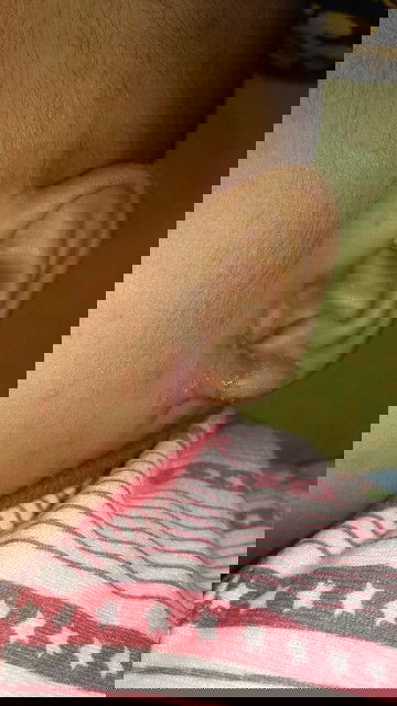 Gatal diarea telinga