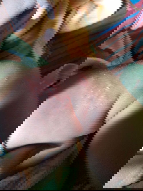 ini alergi atau gatal