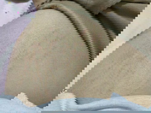 ขอคำแนะนำให้หายคันจากแม่ๆ หน่อยค่ะ คันยุบยิบ มากเลยค่ะ ☺️
ขอบคุณค่ะ