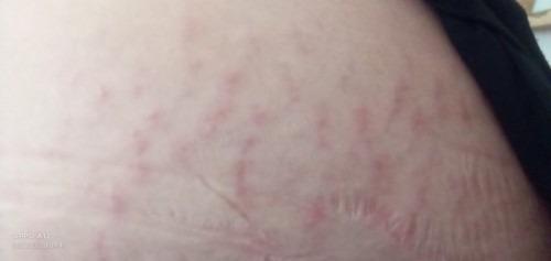 Hi. May i know po kng anong gamot nto dko ksi mpgilan sbrang kati pero sabi nla normal nman daw po .