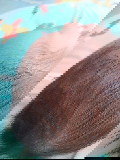 Kulit kepala bayi banyak yang melenting