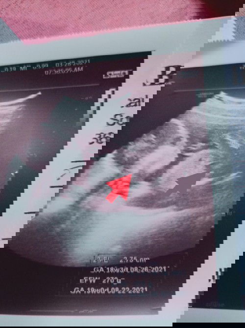 19 weeks 1 day, baby boy👶😍