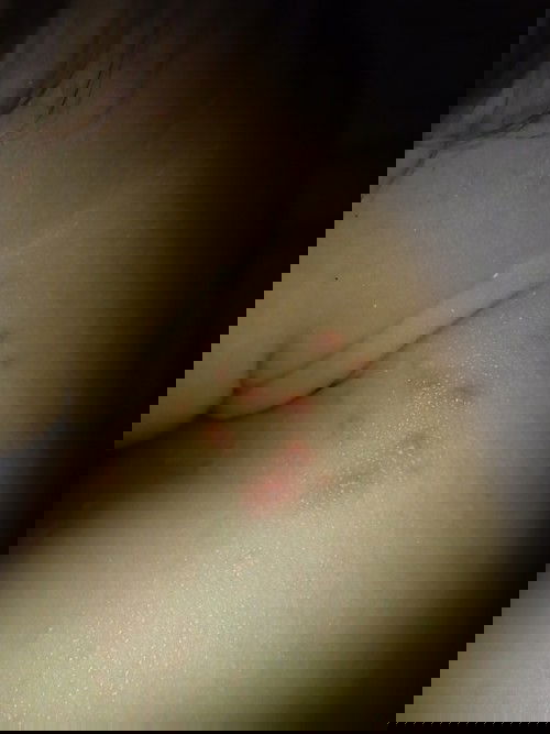 Bintik merah pada bayi