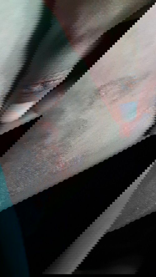 Nih bun lipatan paha nya jdi begini, kenapa yah bun ? trusss obatnya apa yah bun? Enggak sembuh2 nih