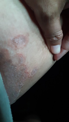 Nih bun lipatan paha nya jdi begini, kenapa yah bun ? trusss obatnya apa yah bun? Enggak sembuh2 nih