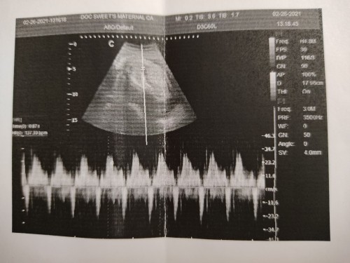 May tendency po ba manganak ako ng CS kapag nasa malapit sa cervix ang placenta?