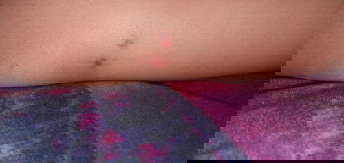 Cacar air pada anak 18bulan