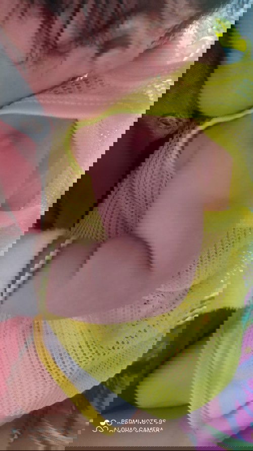 Các mẹ cho e hỏi bé nhà e chích ngừa 1 tháng rồi mà giờ chỗ chích ngừa nổi mũ có phải bây giờ mới