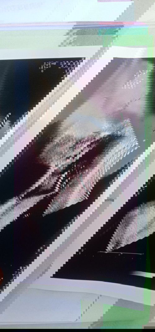 Vanishing Twins syndrom