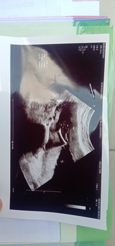 Vanishing Twins syndrom