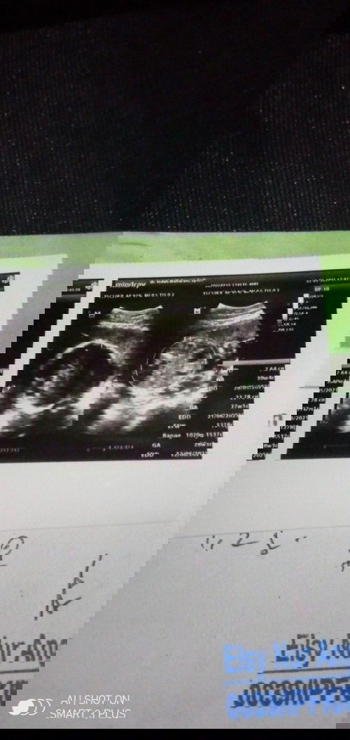 Hasil keterangan dalam foto usg EDD nya ada tiga ?