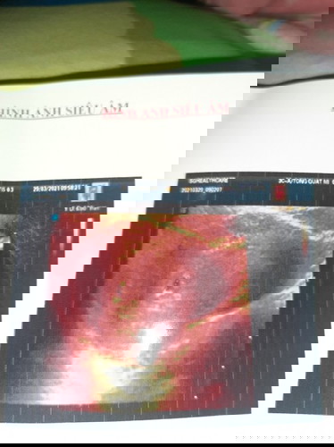 Thai 6mm.kham ma chưa thay phoi voi lai tim thai la sao mn