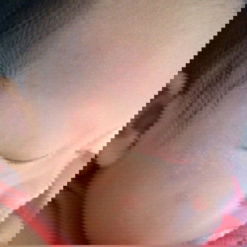 น้องเปนตุ่มใส่ๆขึ้นน่า ขึ้นหู