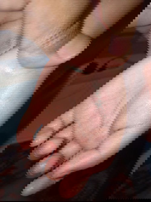 muncul bercak merah lalu bentol