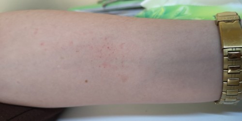 Rashes!!!???