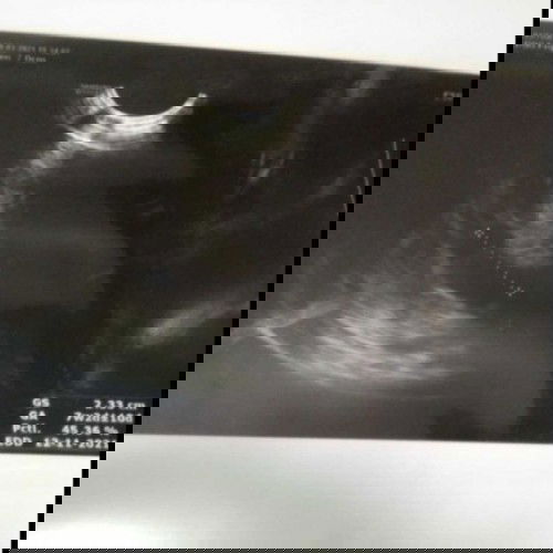 HPHT 12 minggu, tapi dari USG 7 Minggu kenapa sangat berbeda banget iya?