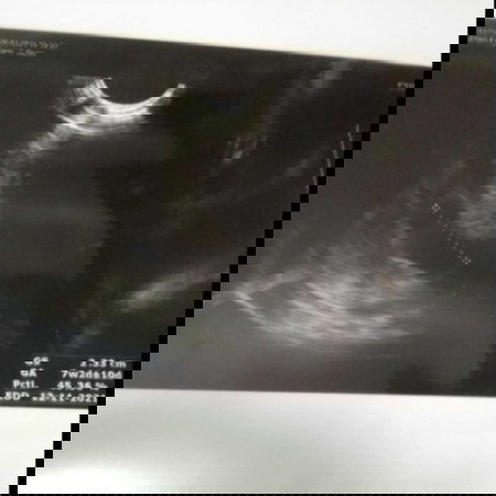 HPHT 12 minggu, tapi dari USG 7 Minggu kenapa sangat berbeda banget iya?