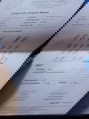 คัดกรองดาวน์ซินโดรม