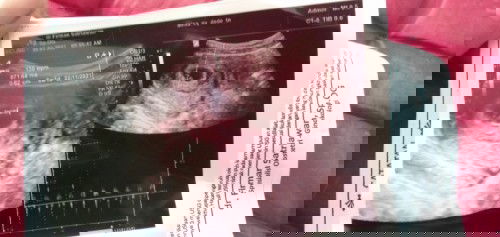 6 Minggu 1 hari ada yg udh kedetek detak jantung janin nya??