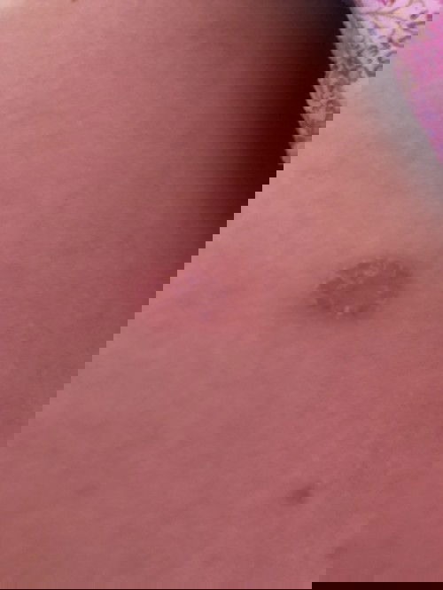 Mình bầu 24 tuần sau lưng xuất hiệu vết này,là sau ạ.là bệnh gì hay là bị zona phải không các m