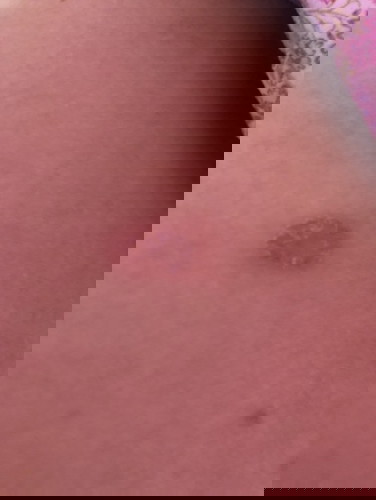 Mình bầu 24 tuần sau lưng xuất hiệu vết này,là sau ạ.là bệnh gì hay là bị zona phải không các m