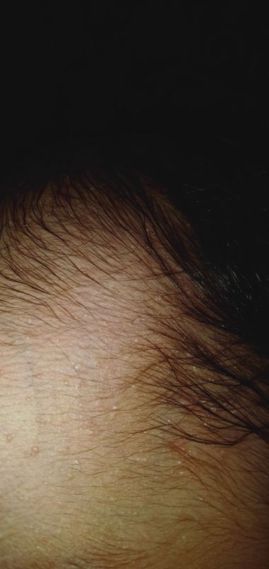 Ini biang keringat kah?