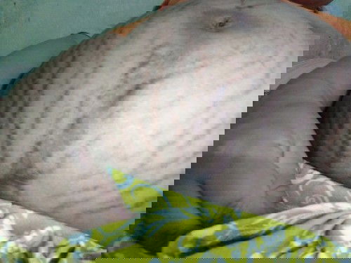 Stretch Marks 😢
Maitim na Batok, Kili kili at Singit 😢😣
Pimples Everywhere 😢😣😣