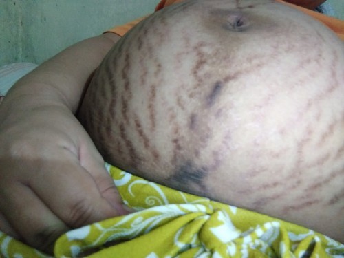 Stretch Marks 😢
Maitim na Batok, Kili kili at Singit 😢😣
Pimples Everywhere 😢😣😣