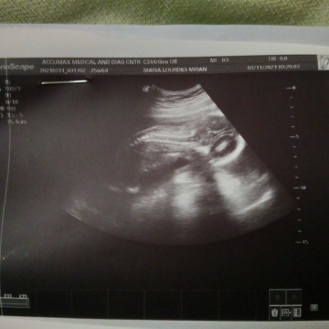 Nakadapa po ang baby, normal ho ba? may gamot po ba para sa manas?π’ on going 6 months pa lang ho.π’