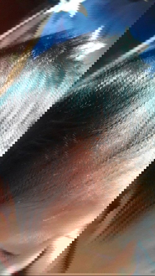 Beruntusan di kepala bayi