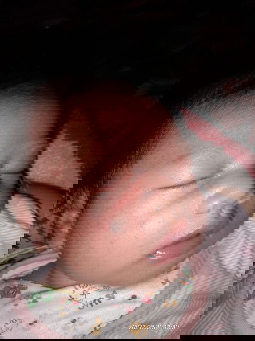 Bintik merah di wajah sampe leher