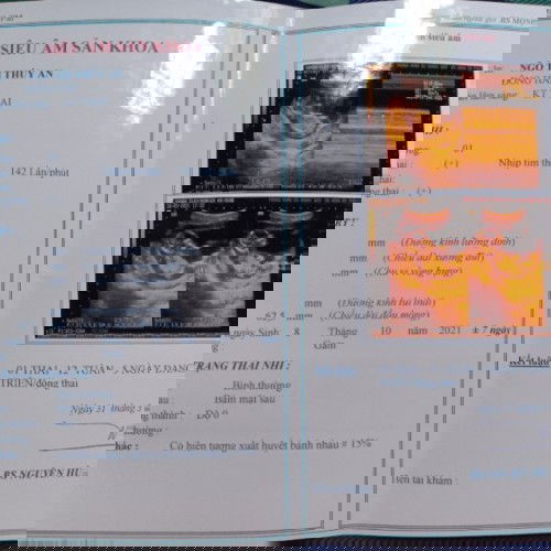 Bé dc 12w rồi mà bị xuất huyết bánh nhau 15% có sau k ạ