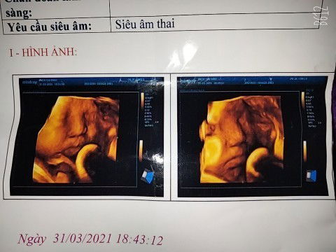 Con e trong bụng giờ ĐK hơn 8 tháng , thời gian mang bầu hay giận hờn hay rỗi,bs bảo nhìn cũng hay