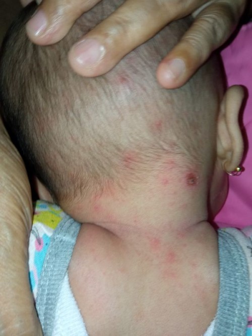 Merah merah di leher dan kepala belakang pada bayi