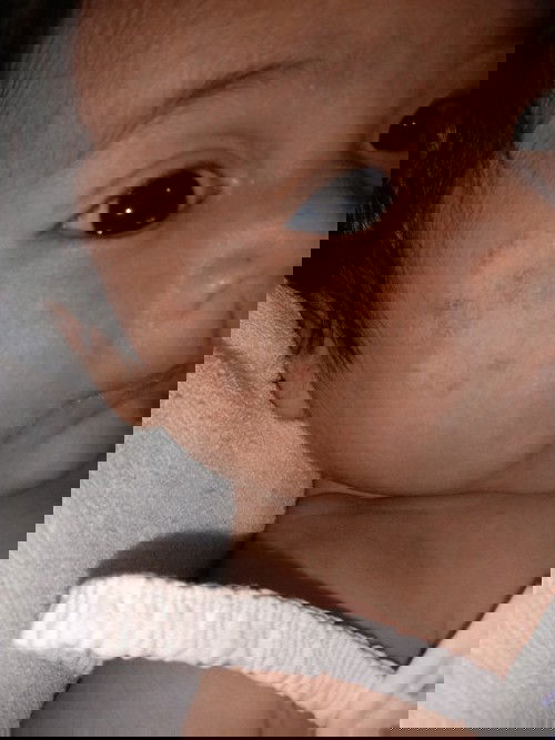 ผื่นขึ้นที่หน้าลูกรักษายังไง