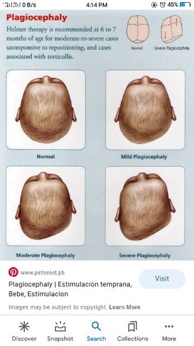 Flat head syndrome(Plagiocephaly)