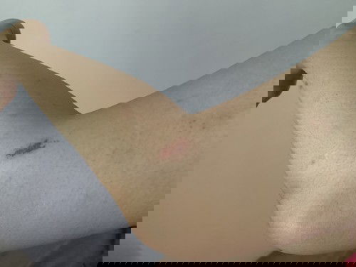 Gatal2 diseluruh badan, masuk TM 3😭